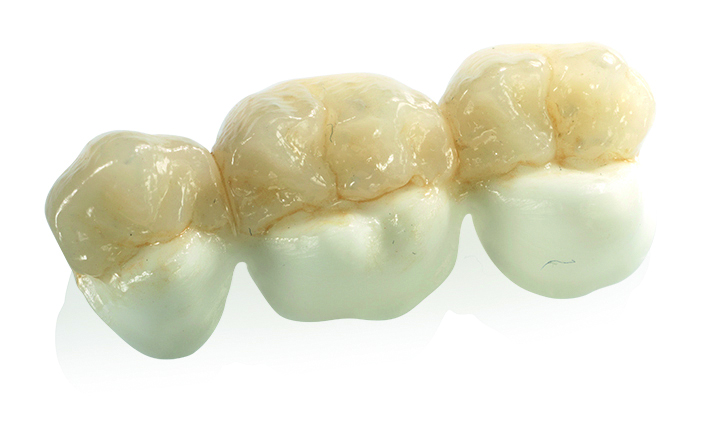 Delna prevleka z uporabo materiala Zenostar MO