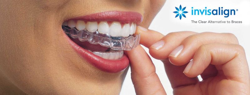 tl_files/images/Tehnologije/Invisalign-Top.jpg tl_files/images/Tehnologije/Invisalign-Top.jpg