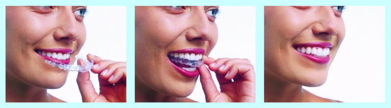 tl_files/images/Tehnologije/Invisalign_01.jpg tl_files/images/Tehnologije/Invisalign_01.jpg